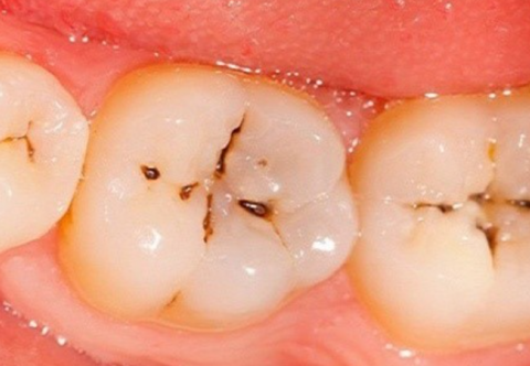 Vết đen trên răng hàm: Nguyên nhân và cách loại bỏ